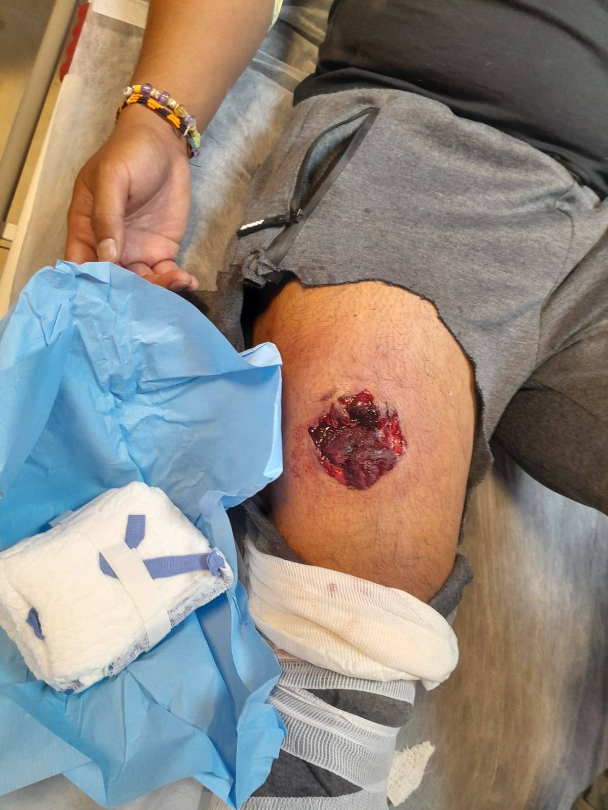 The exit wound caused by live ammunition in Amado Sison's though